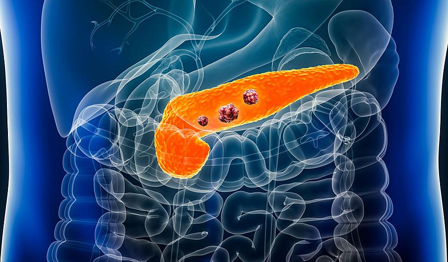 Imagen de un páncreas con tumores