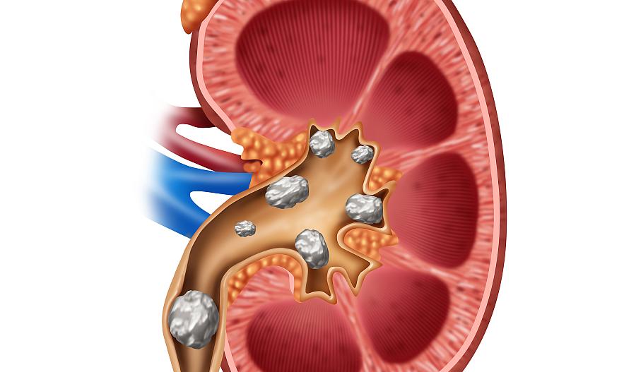 Ilustración de un riñón con cálculos renales en su interior.